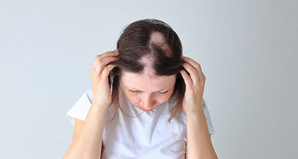 A person with alopecia areata